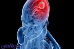 ارتباط سندروم ژنتیکی و تومور مغزی در کودکان